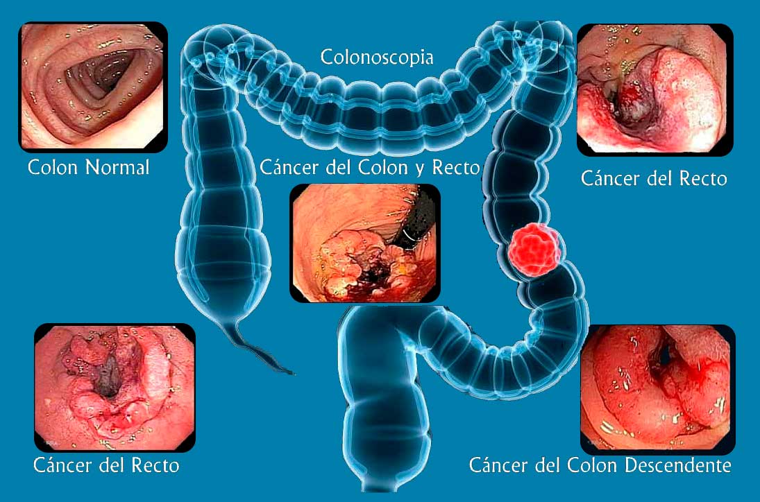 colonoscopia-2